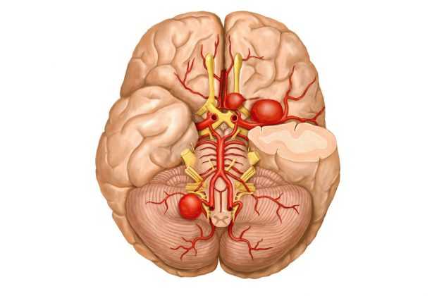 ангиома головного мозга